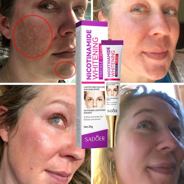 Nicotinamide Whitening Freckles Cream Remove Melasma Dark Spot Acne Marks Lightening Melanin Brightens Skin Tone Face Skin Care